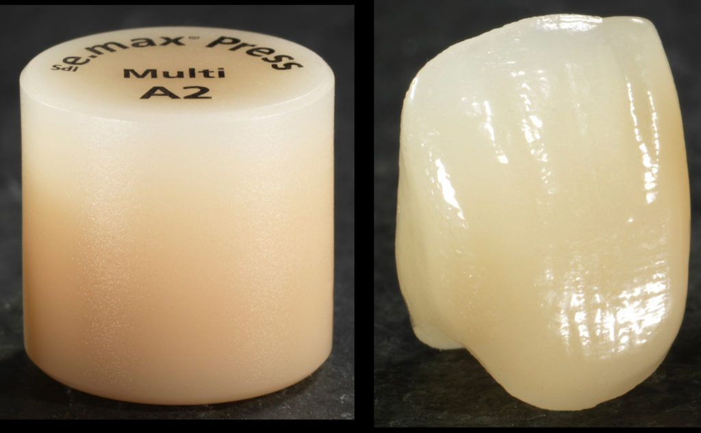 IPS e.max | Digital Dental Arts Laboratory
