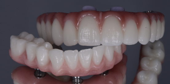 Full Mouth Rehab with Zirconia Maxillary Arch and Mandibular Acrylic Resin Titanium