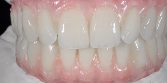 Implant Supported Provisional Restorations