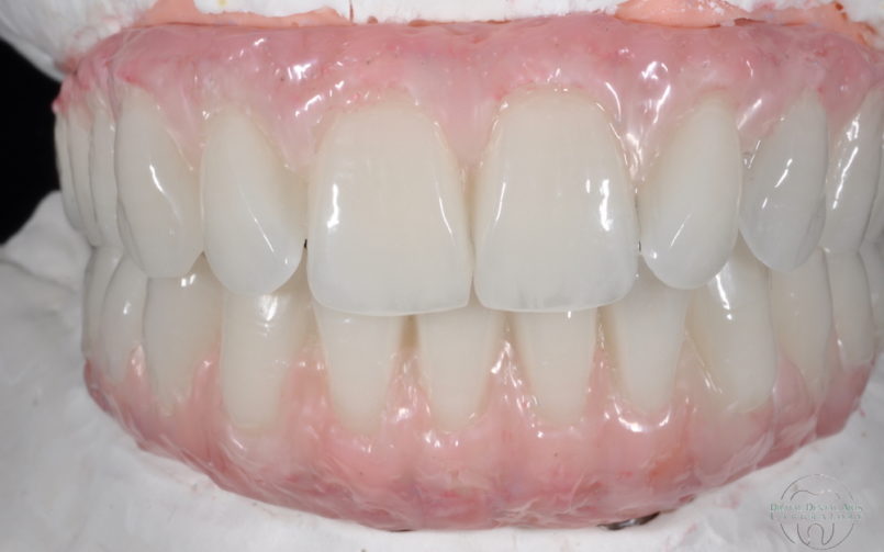 Implant Supported Provisional Restorations