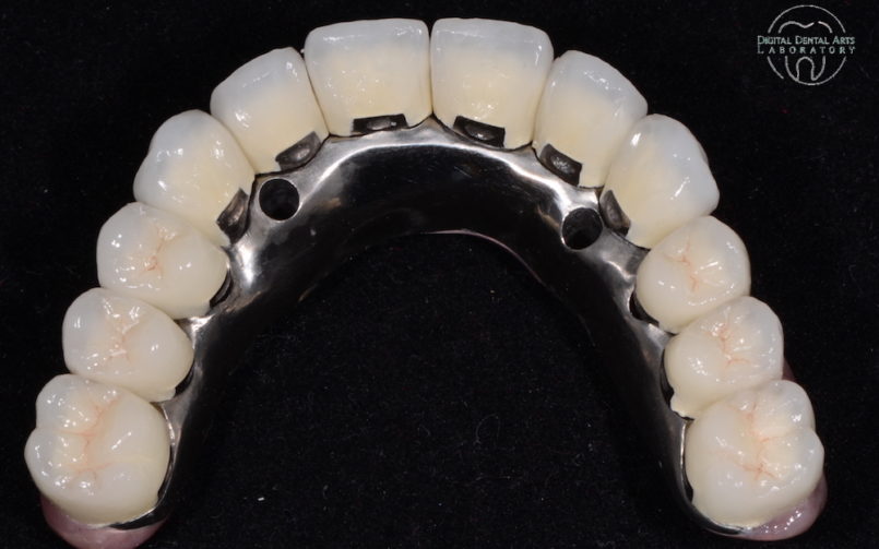 Individual PFM Crowns