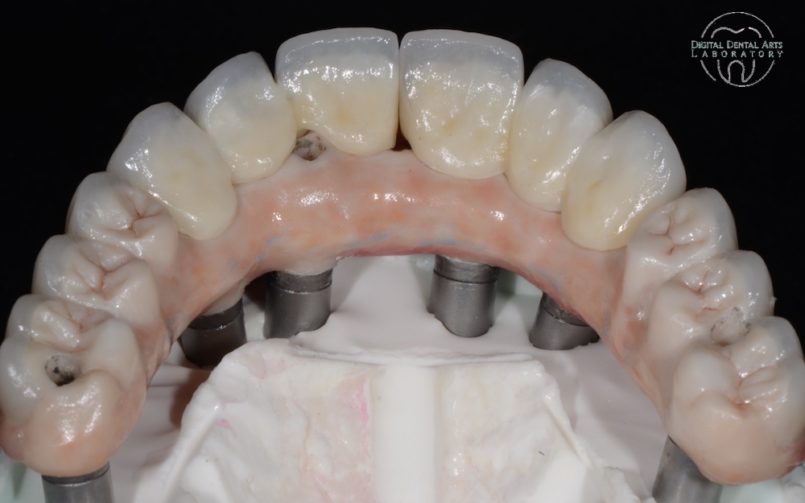 Individual Zirconia Crowns