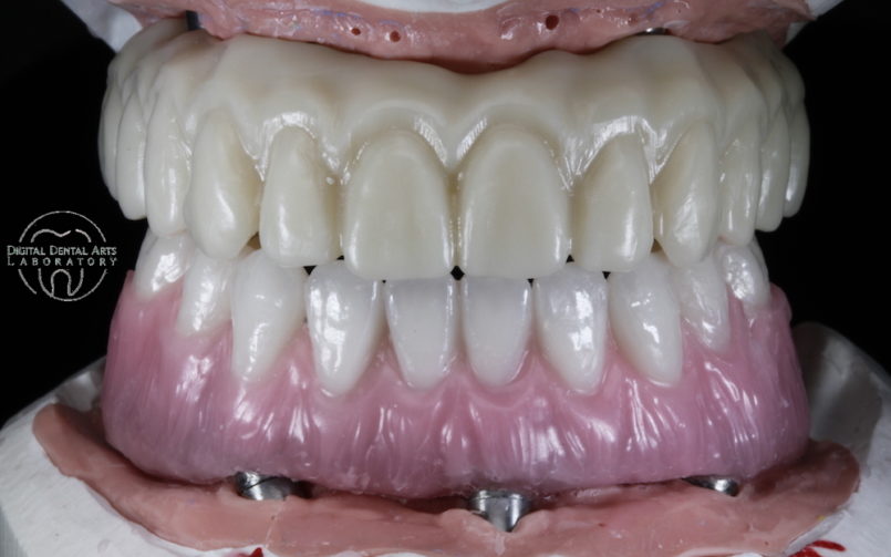 Maxillary Prototype