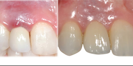 Natural anterior implant crowns