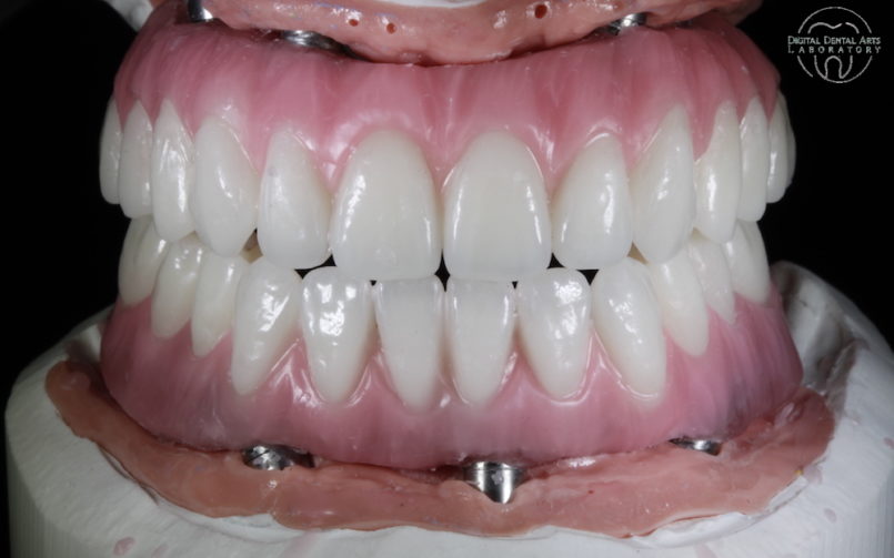 Upper Full Arch Wax