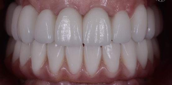 Upper Tooth Only All On 4 in Zirconia