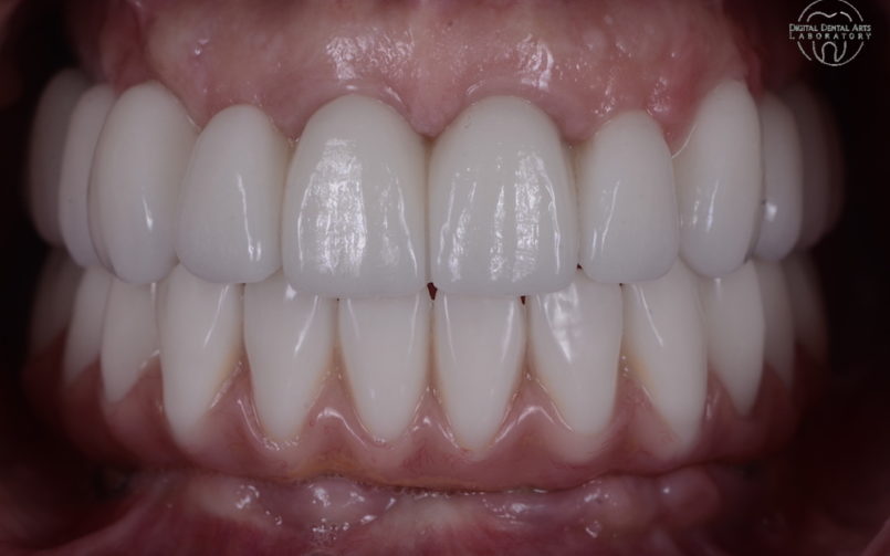 Upper Tooth Only All On 4 in Zirconia
