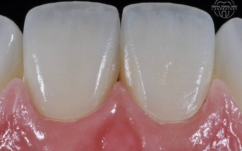 Zirconia Crowns