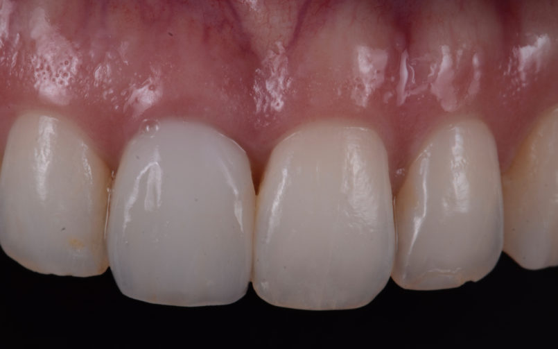 implant provisionals